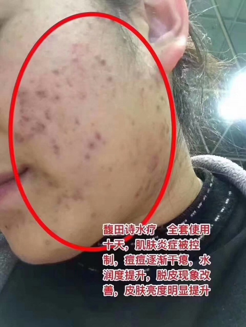 馥田詩(shī)水療，全套使用十天，肌膚炎癥被控制，痘痘逐漸干癟，水潤(rùn)度提升，脫皮現(xiàn)象改善，皮膚亮度明顯提升。