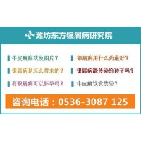 濰坊看銀屑病專業的療法